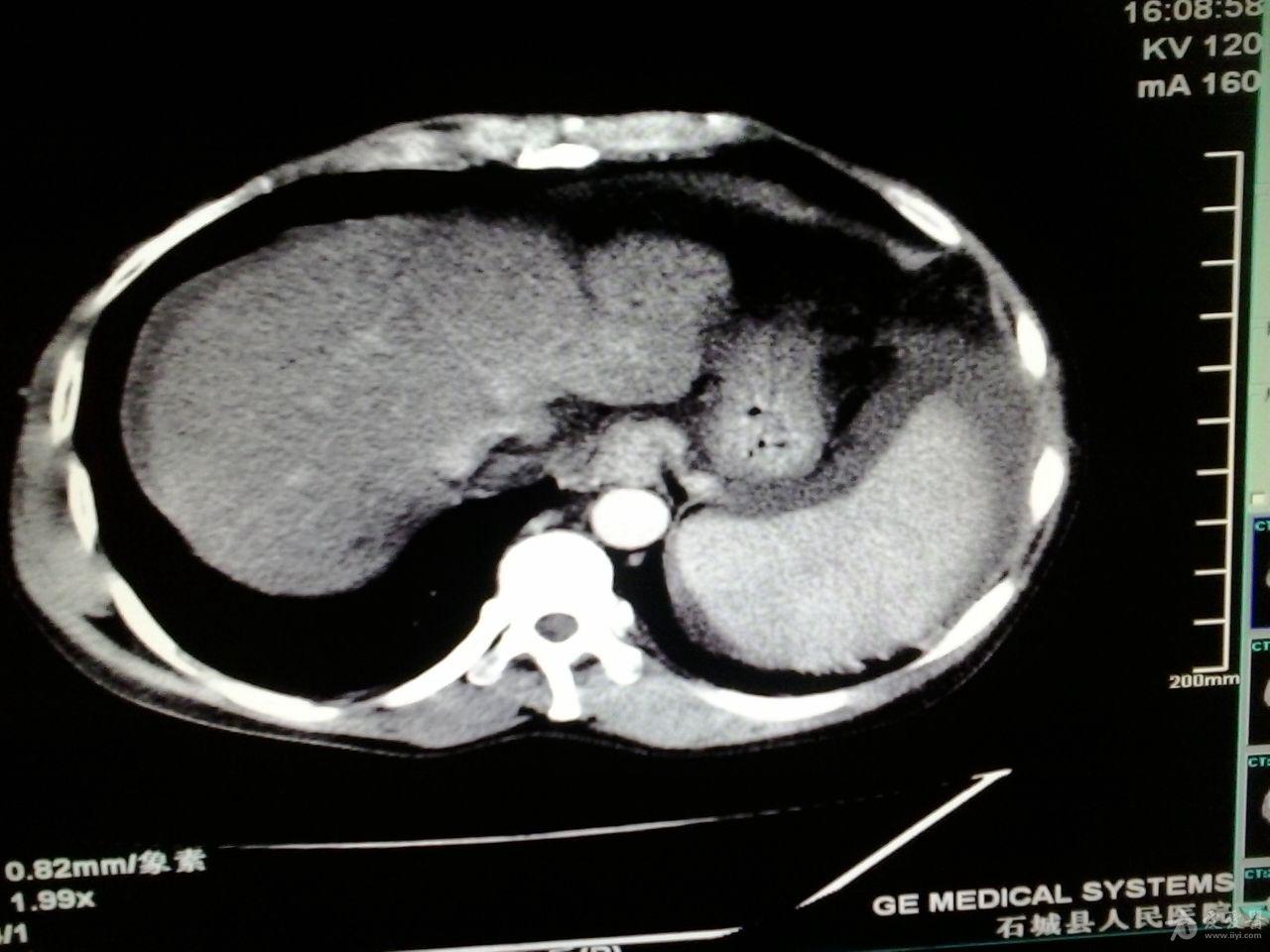 肝内结节分析