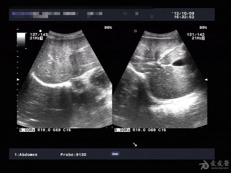 肝脏挫裂伤一例(有复查对照).