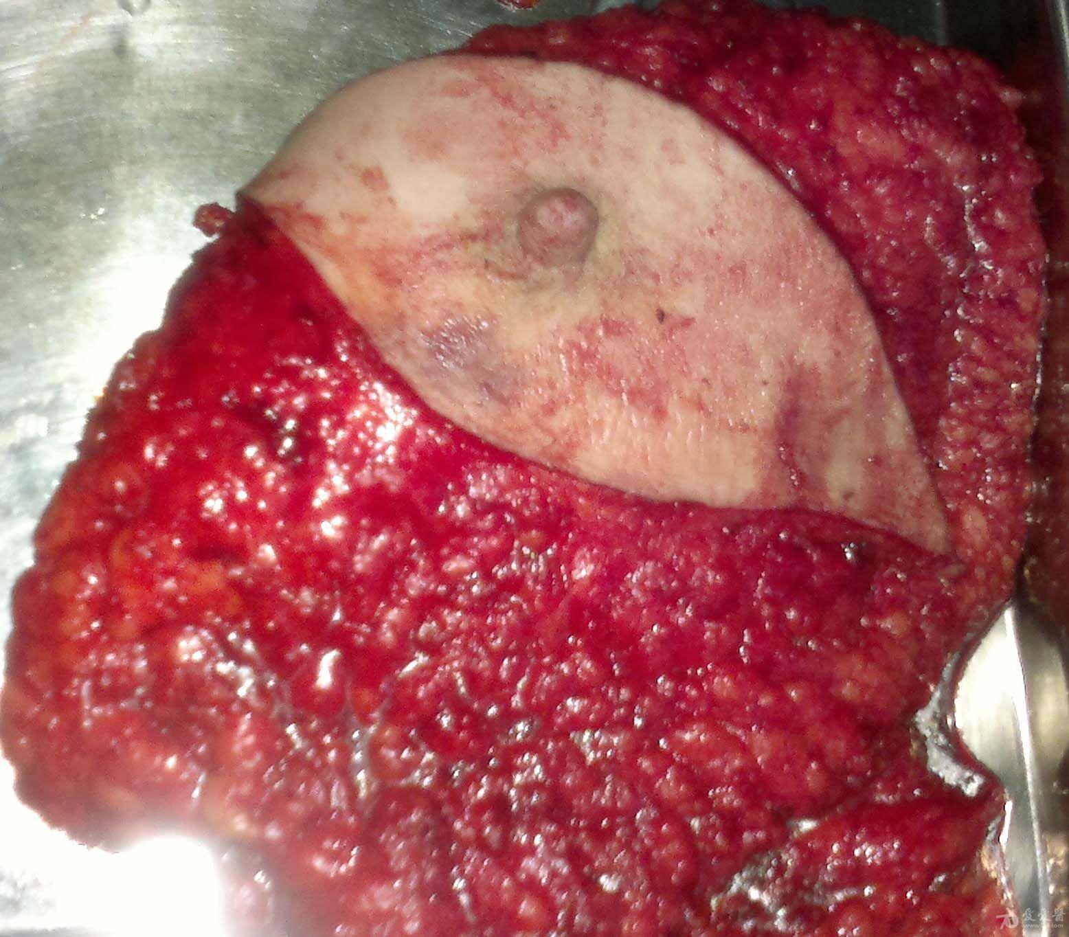 乳腺导管瘤术后照片图片