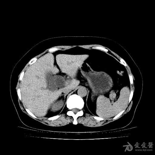 肝内胆管扩张图片