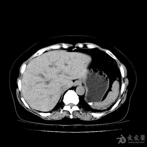 肝窦扩张图片