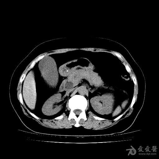 胆管ct正常图解图片