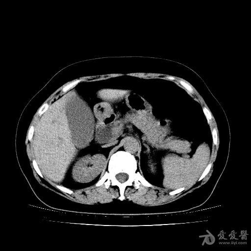 肝内胆管扩张ct图片