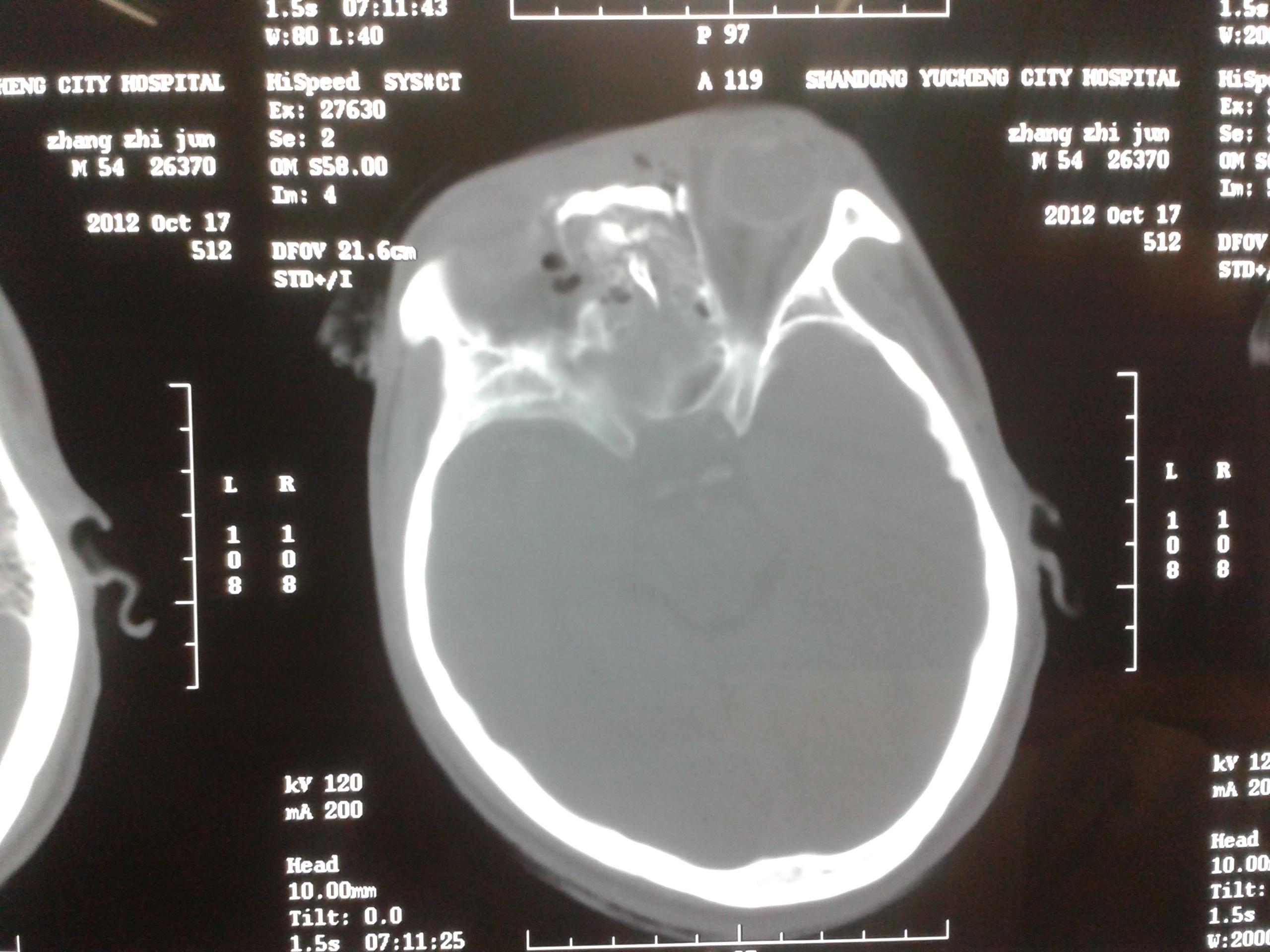头骨骨折x光片图片
