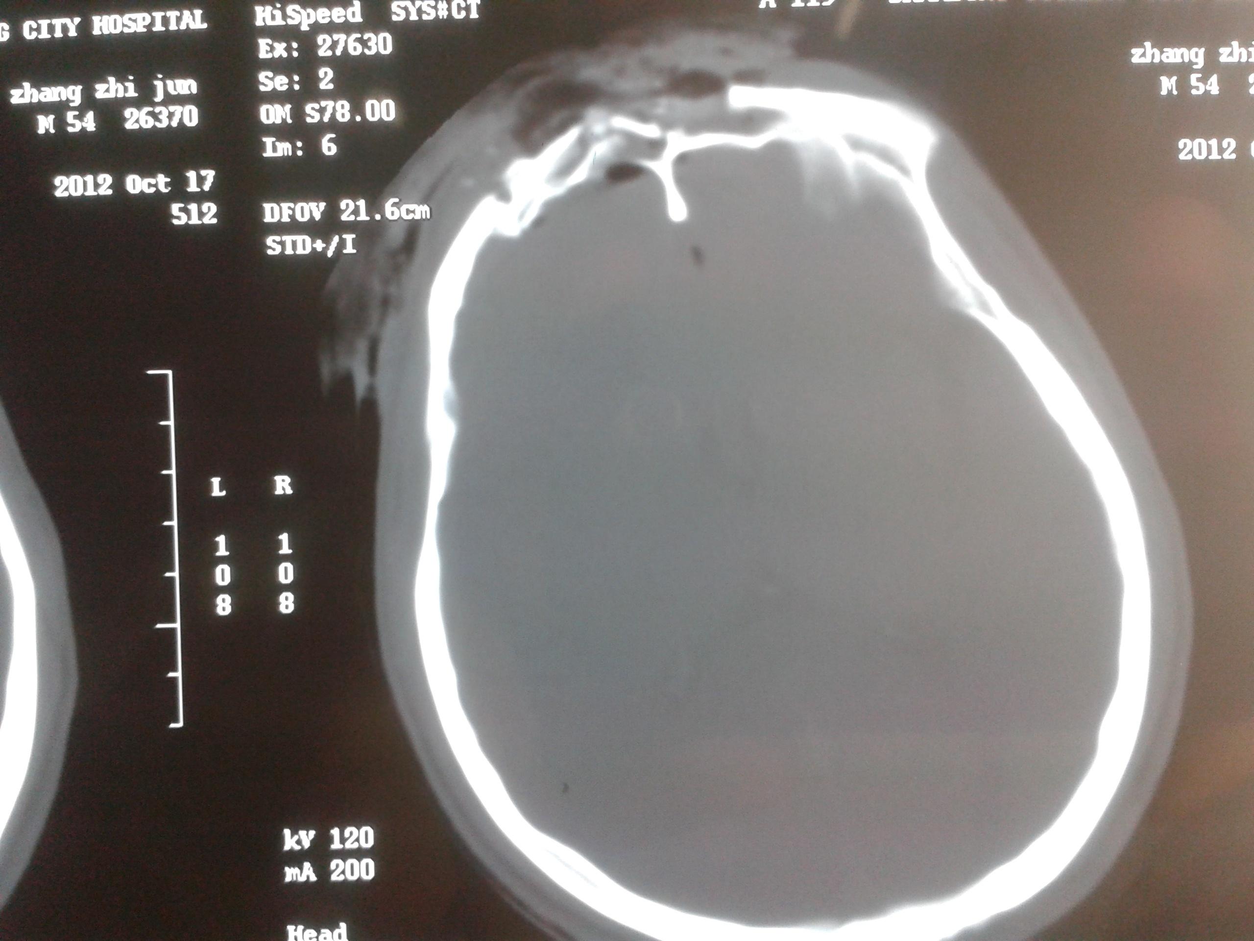 头骨骨折x光片图片