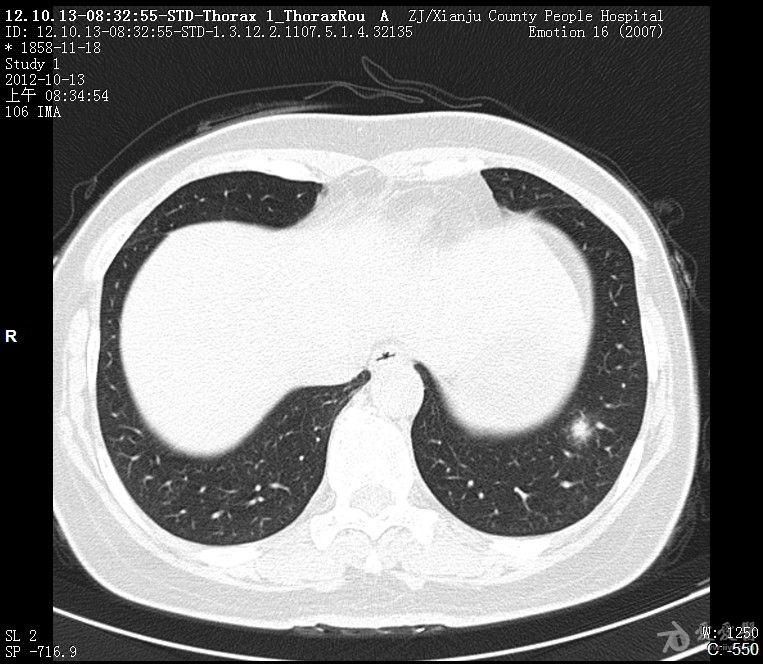 左肺下叶小结节灶,请会诊
