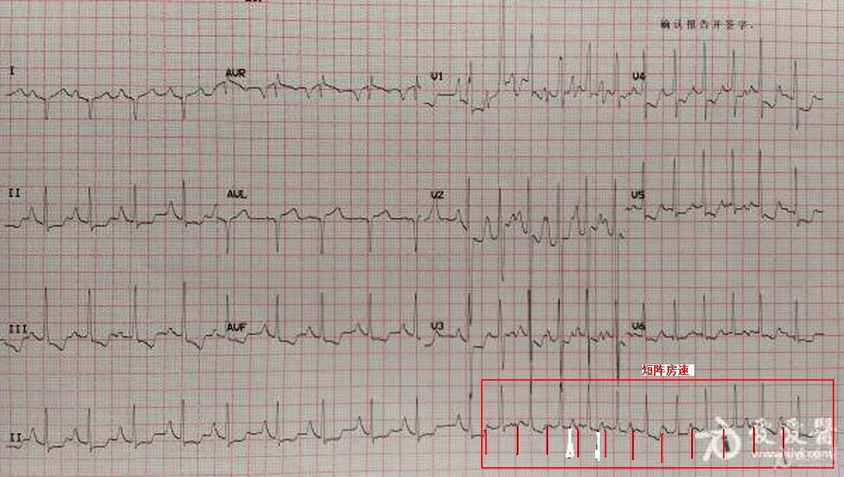 心包炎心电图特征图片