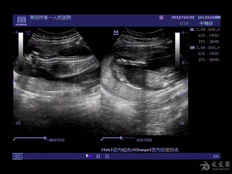 无脑儿 - 超声医学讨论版 - 爱爱医医学论坛