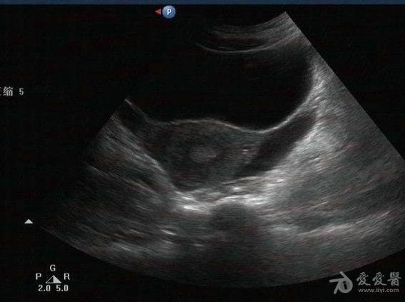 这是输卵管积水吗