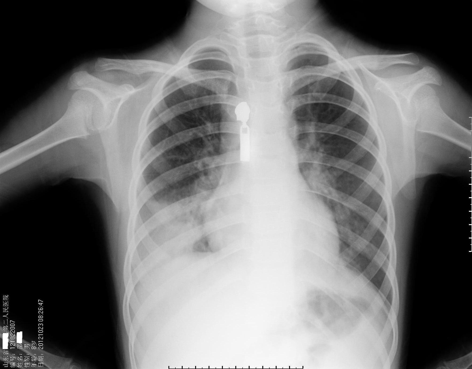 肺炎的x光片图片