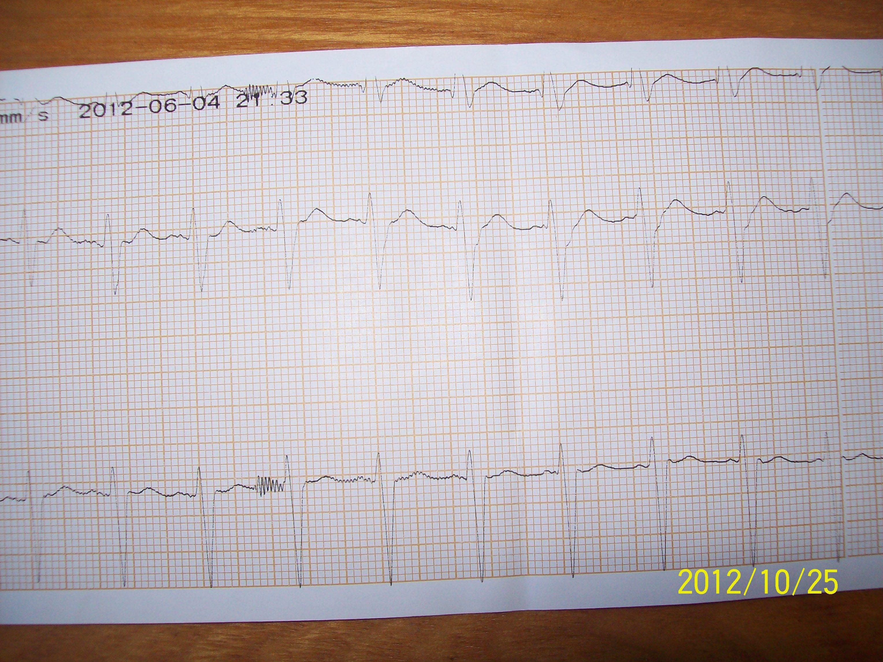 一份临终心电图
