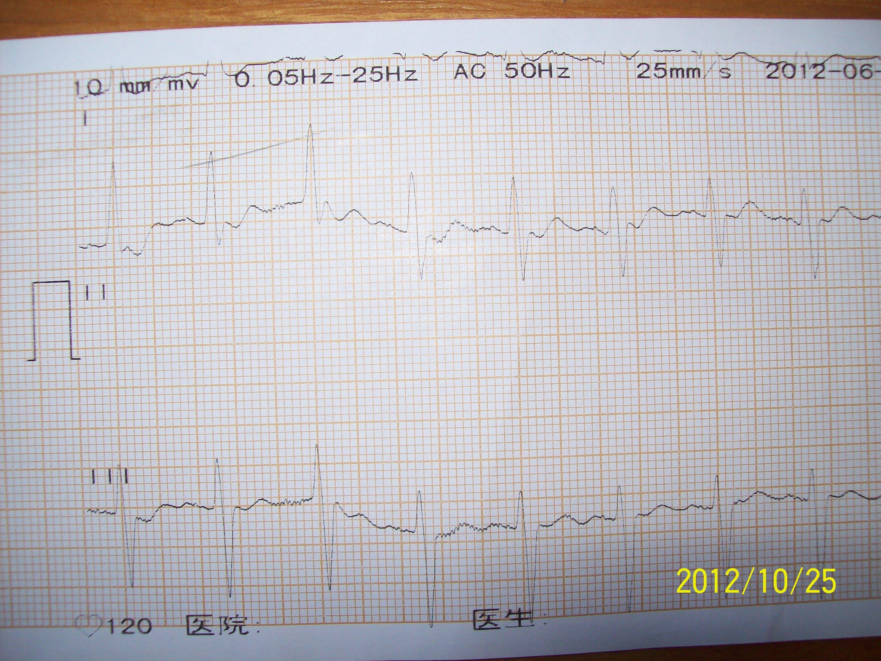一份临终心电图
