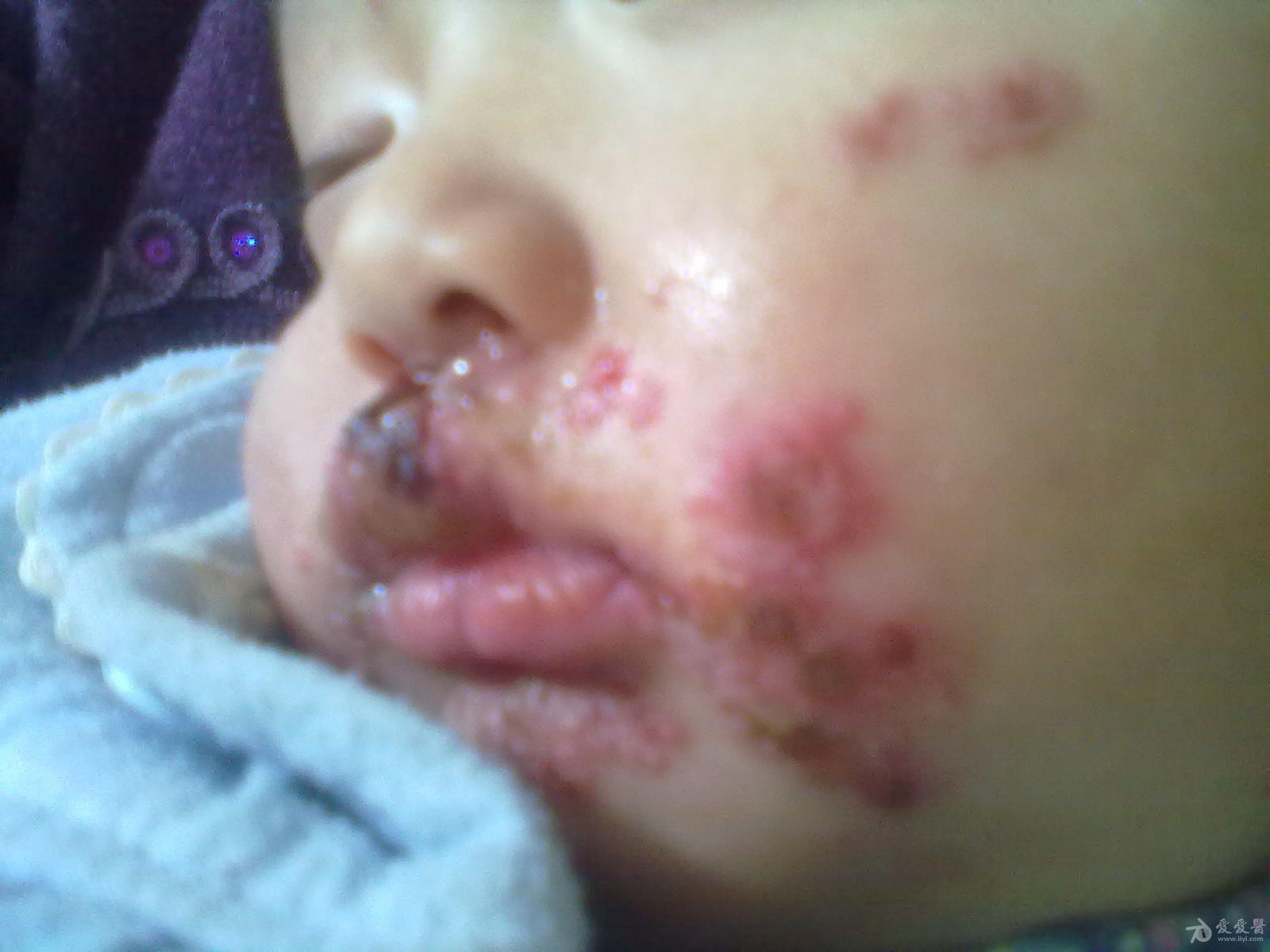 一岁半宝宝口周大片疱疹