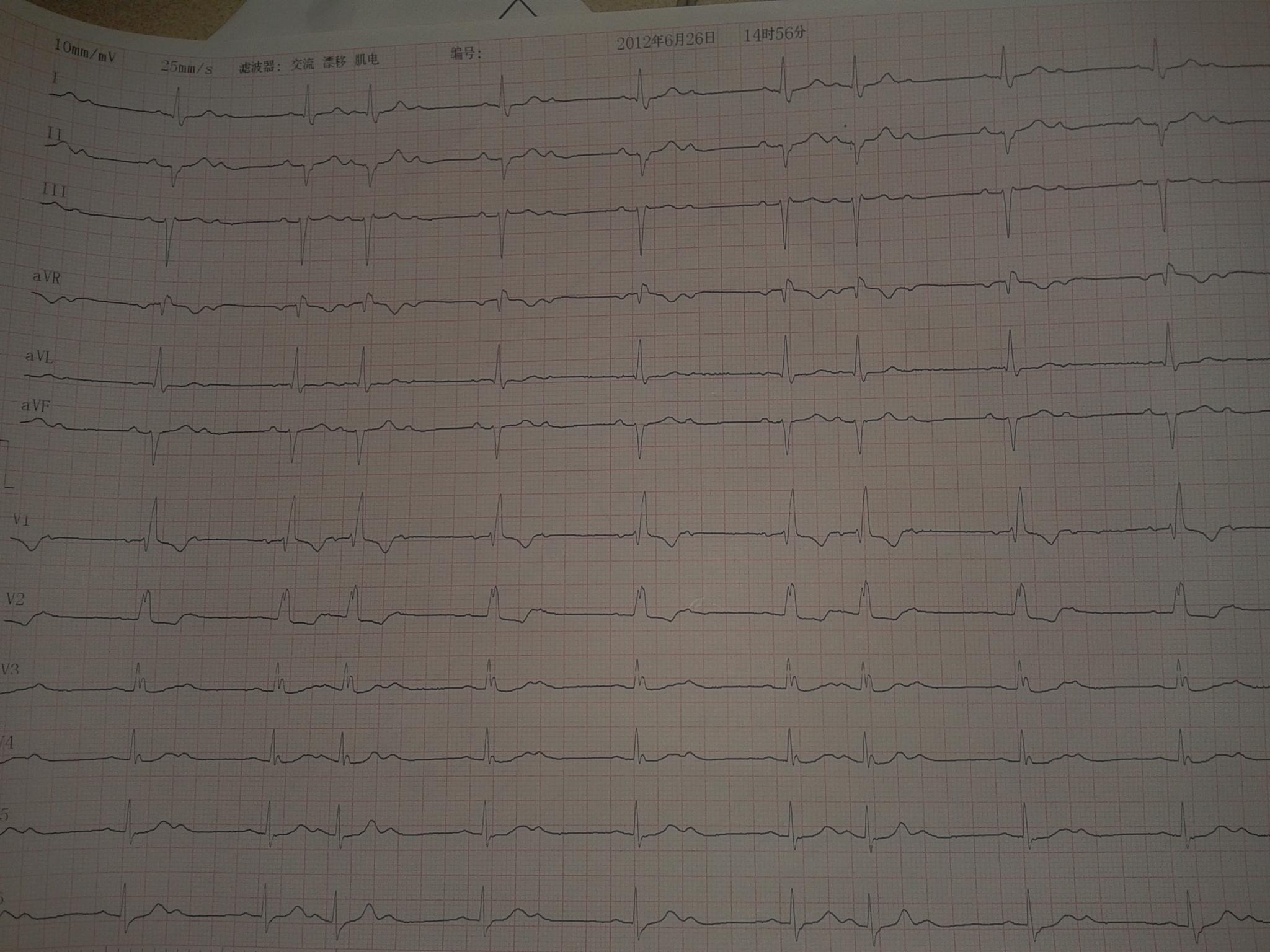 ii度房室传导阻滞ii型(1比1脱落,完右,异常q波1-1.jpg