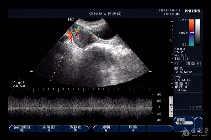 子宫动静脉瘘超声图片