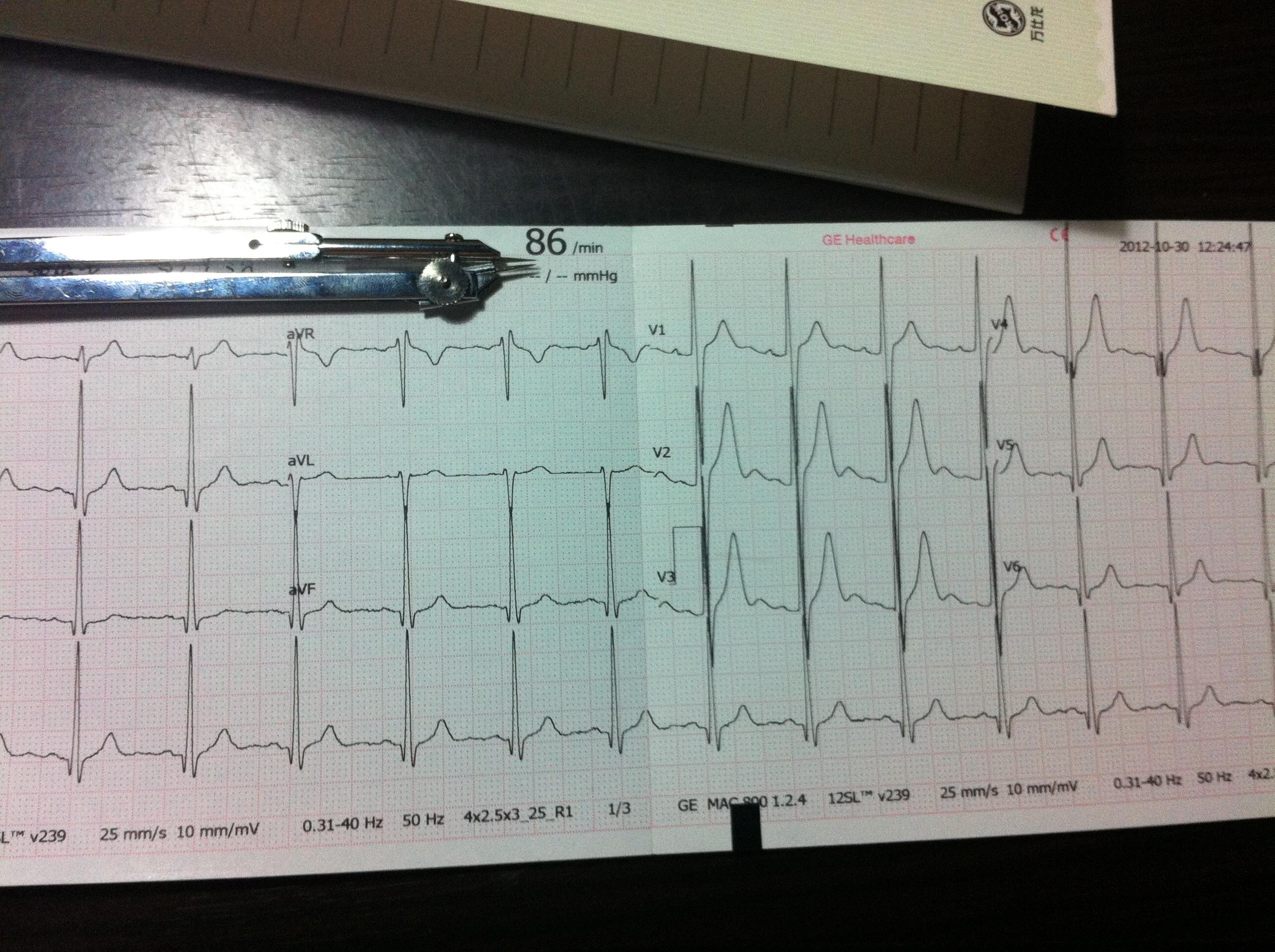 求助心電圖