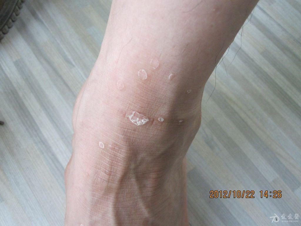 花斑糠疹为什么这么难治