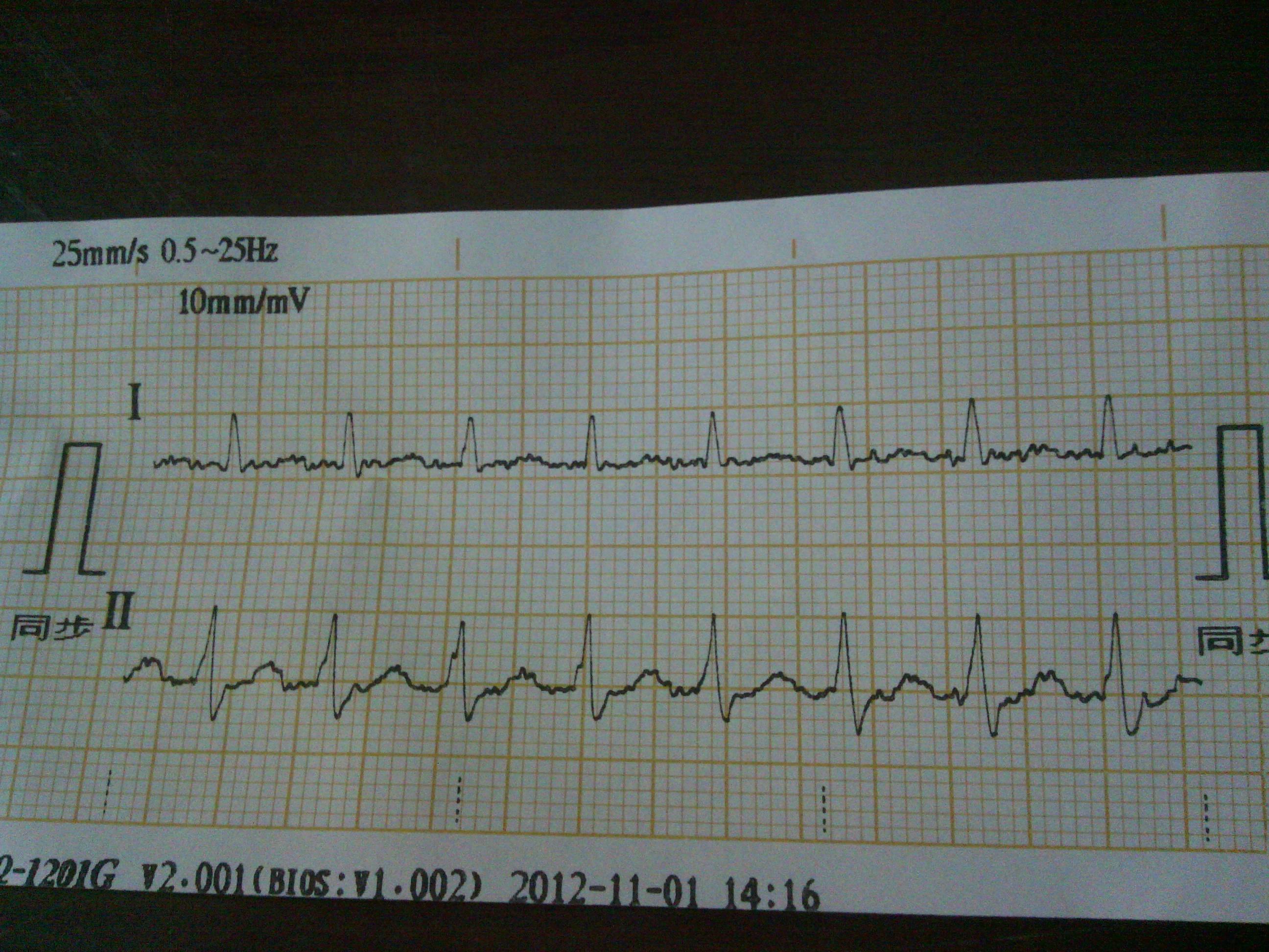 突發心悸心律168bpm