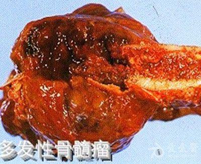 冒烟型骨髓瘤图片