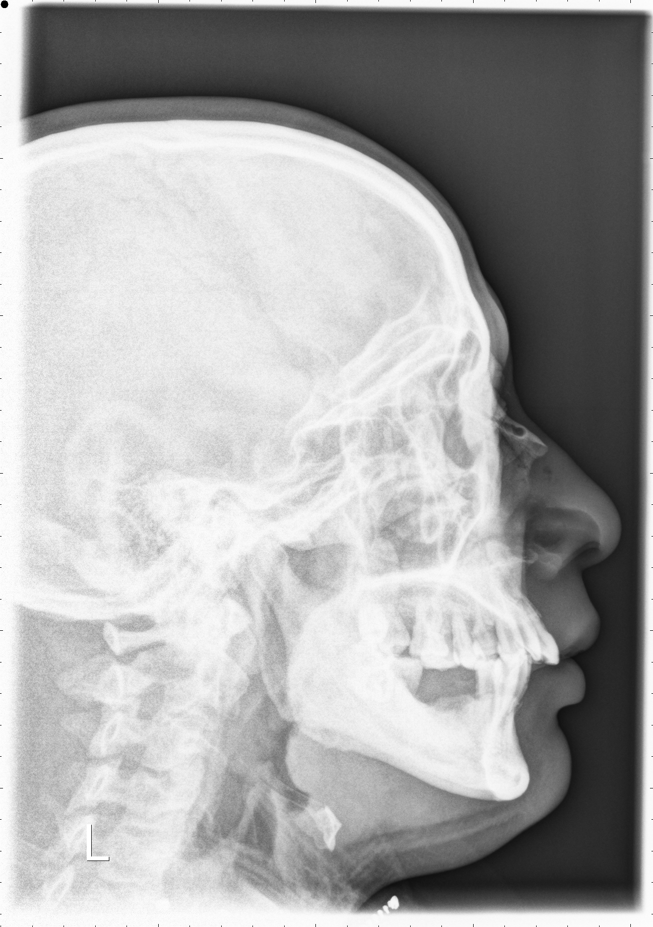 鼻骨正侧位x光片图片