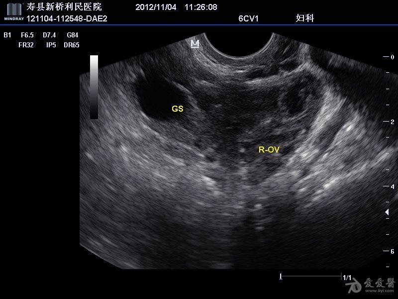 输卵管堵塞彩超图片