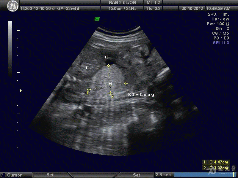 胎儿隔离肺图像共赏 - 超声医学讨论版 - 爱爱医医学论坛