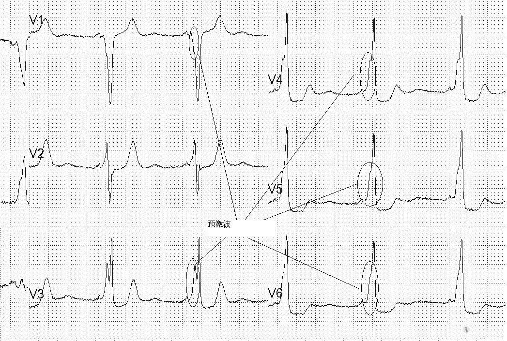 心室预激心电图图片