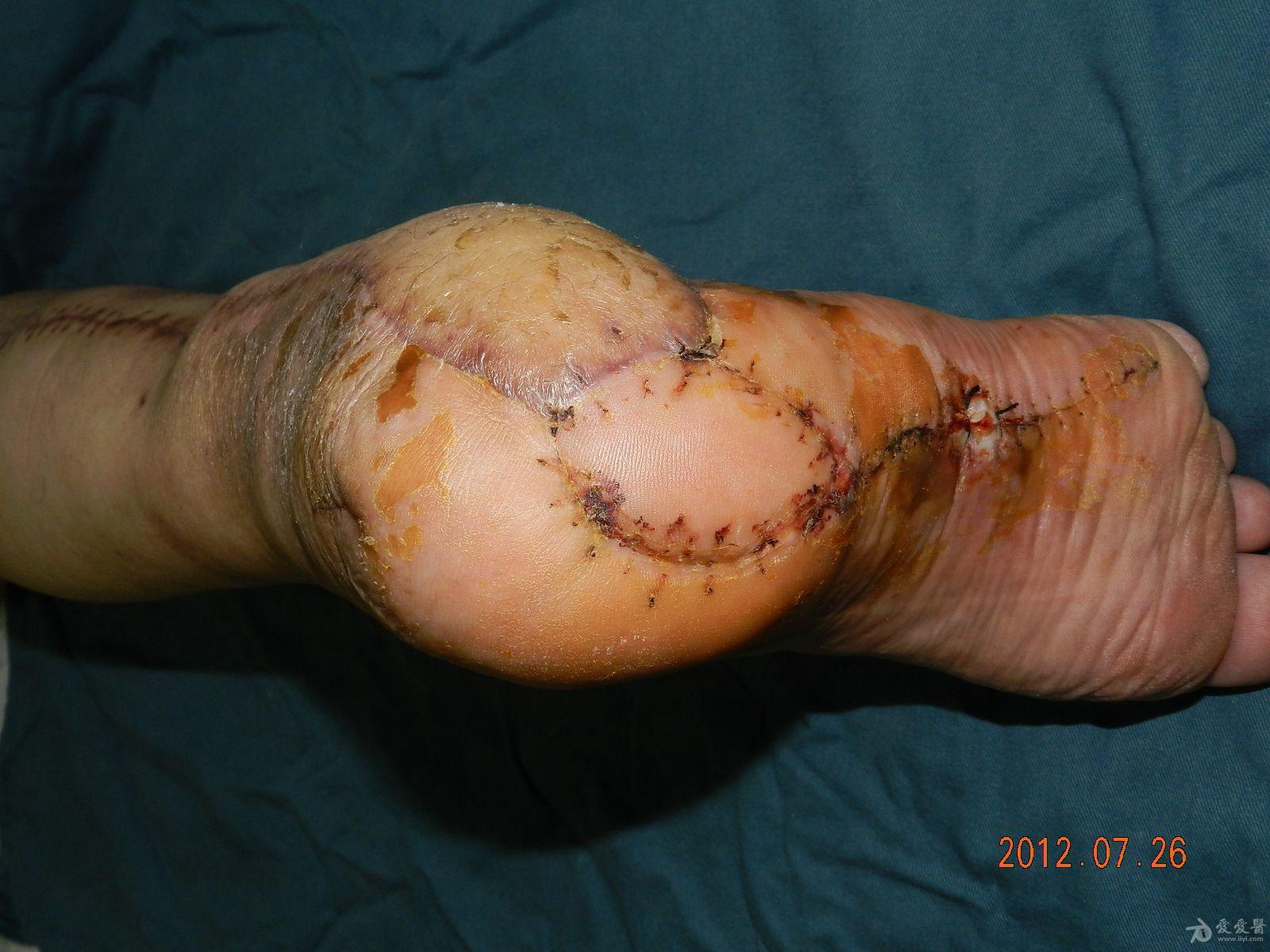 千方百计治愈一例跟骨慢性骨髓炎21年根部溃疡15年经久未愈的病例