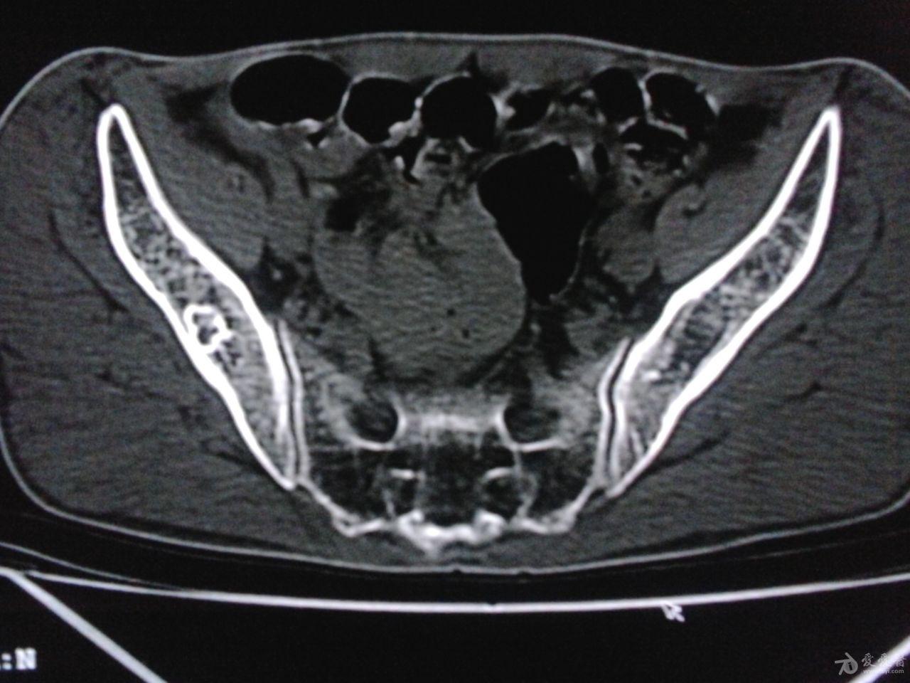 右侧髋臼及髂骨病变