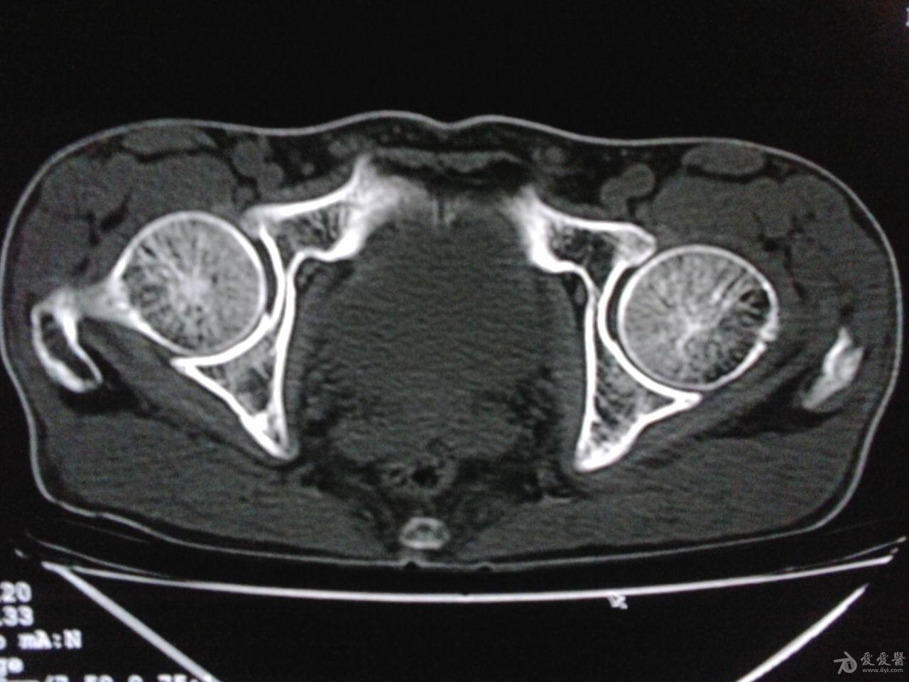 右侧髋臼及髂骨病变