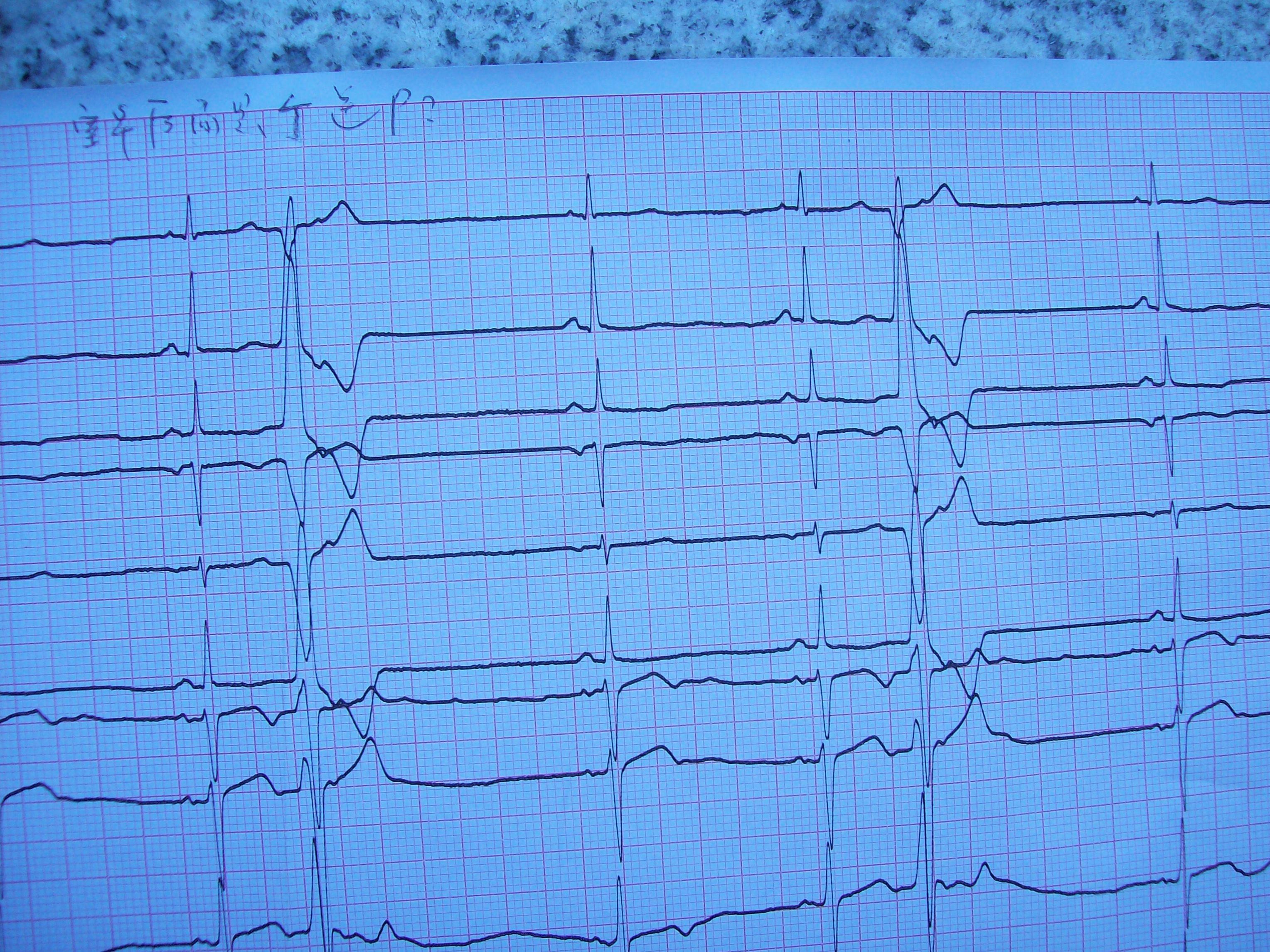 室性早搏的心电图波形图片