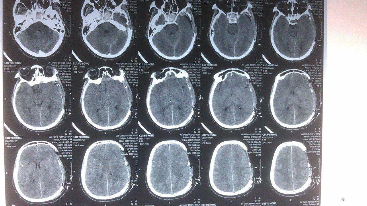 硬膜下血肿ct图图片