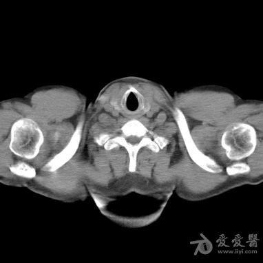 锁骨下动脉ct图片