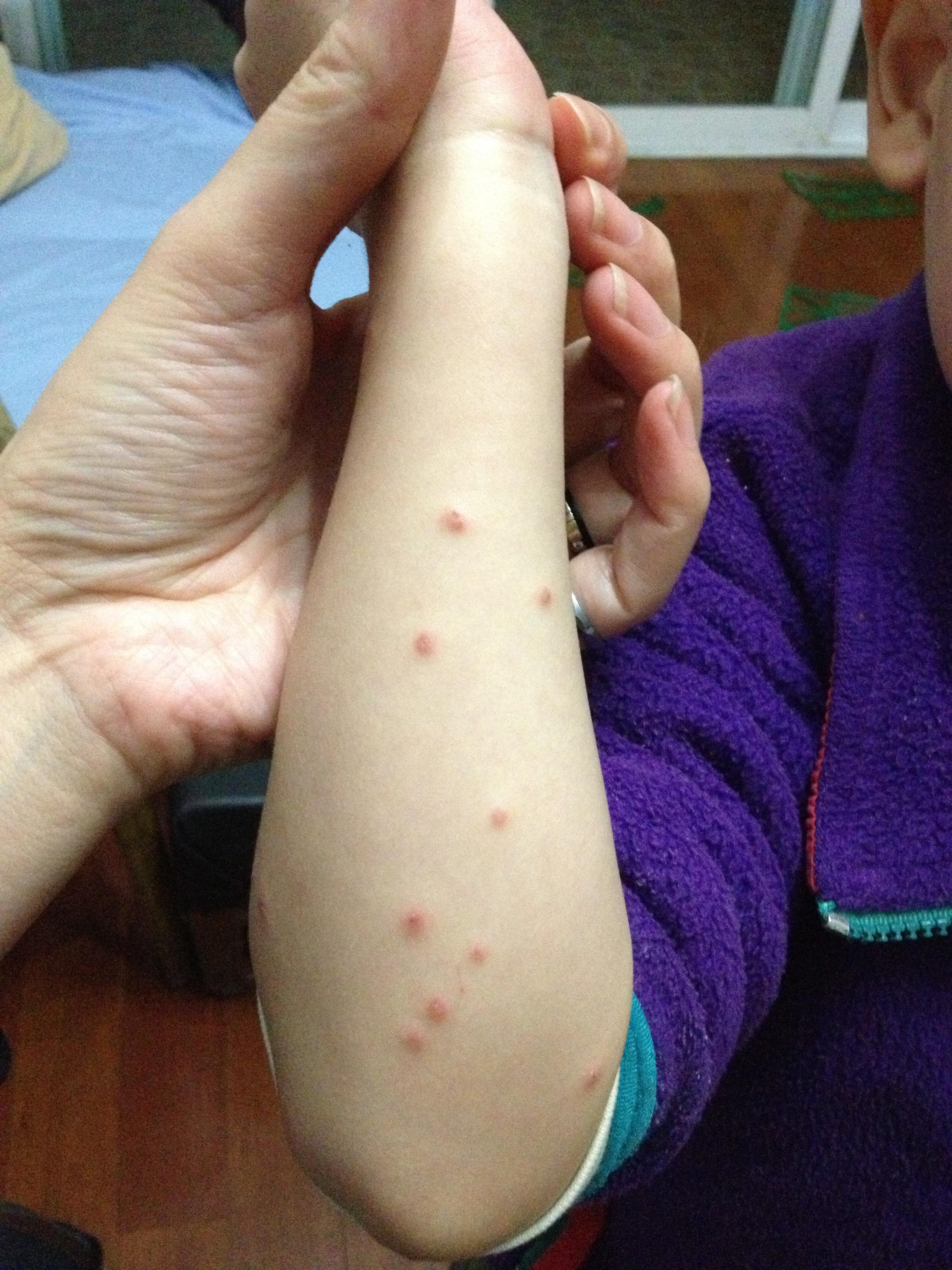 儿童起疹子的症状图片图片
