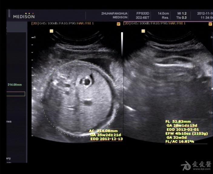 胎儿腹腔积液,羊水多,右心增大. - 超声医学讨论版 - 爱爱医医学论坛