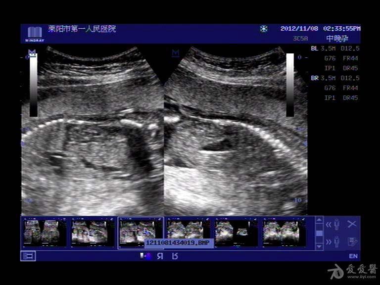 胎儿颈部淋巴管瘤图片图片