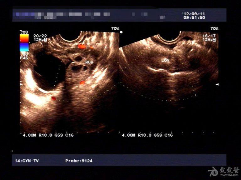 右侧卵巢囊性包块图片