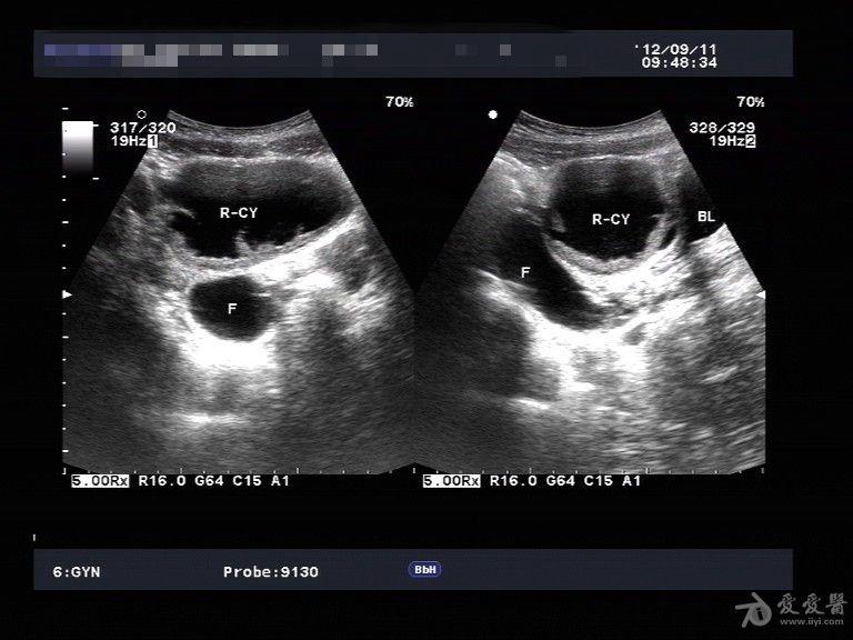 右侧附件区囊性包块(有病理)