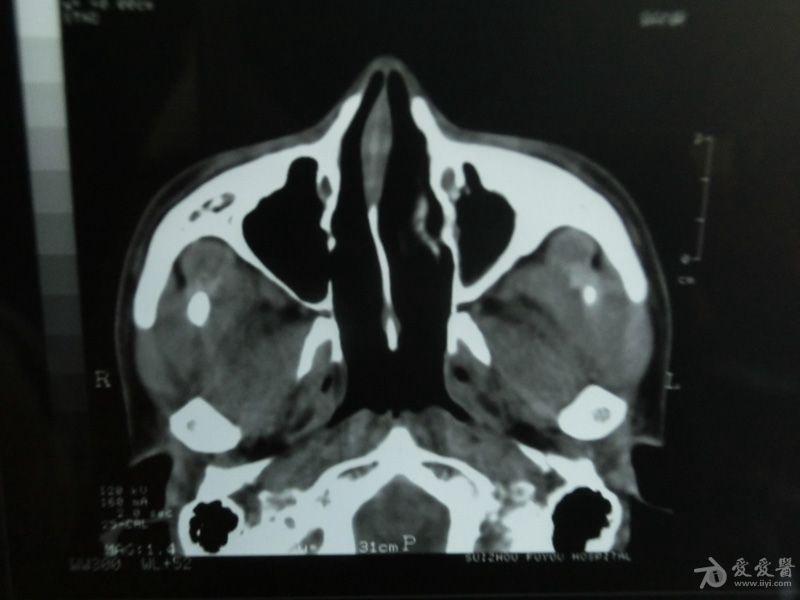 副鼻窦冠状位图片图片