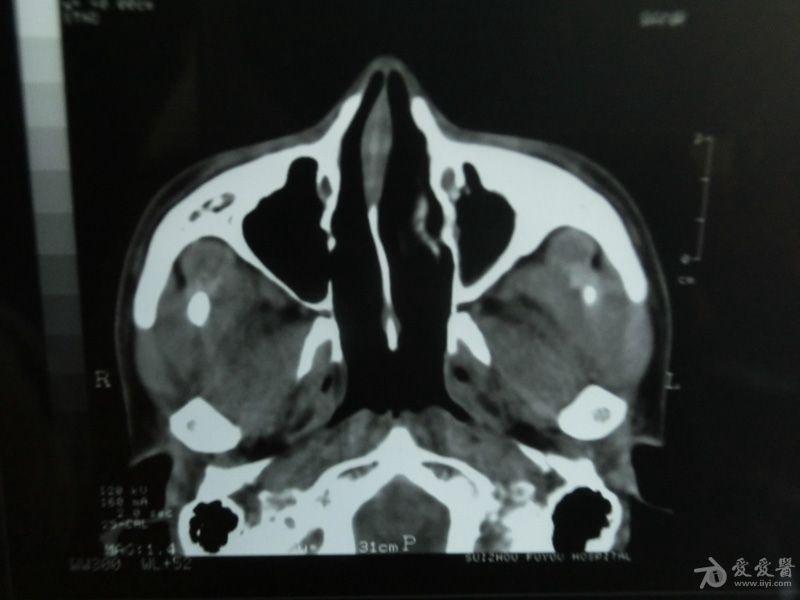 副鼻窦ct轴位 冠状位平扫,请各位专家帮忙看下,万分感谢!