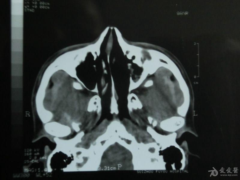 副鼻窦冠状位图片图片