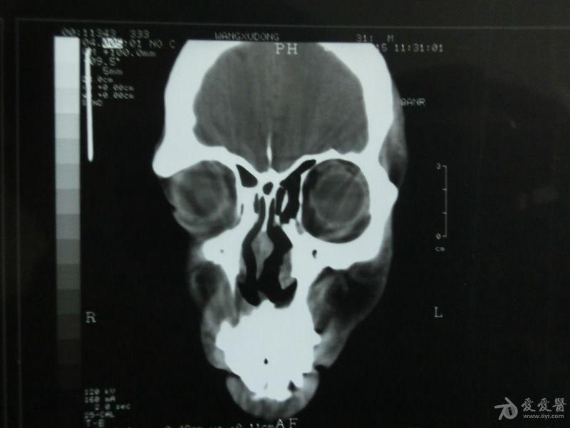 副鼻窦ct平扫图片图片