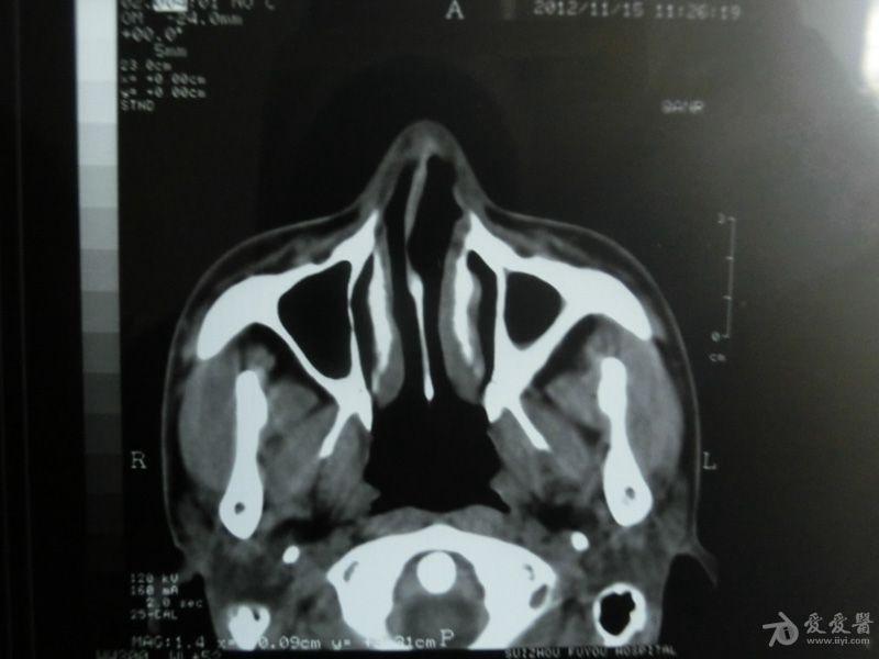 副鼻窦ct平扫图片图片