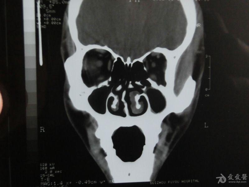 副鼻窦ct图像图片