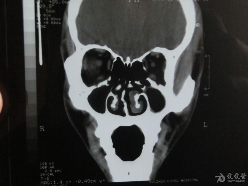 副鼻窦ct平扫图片图片
