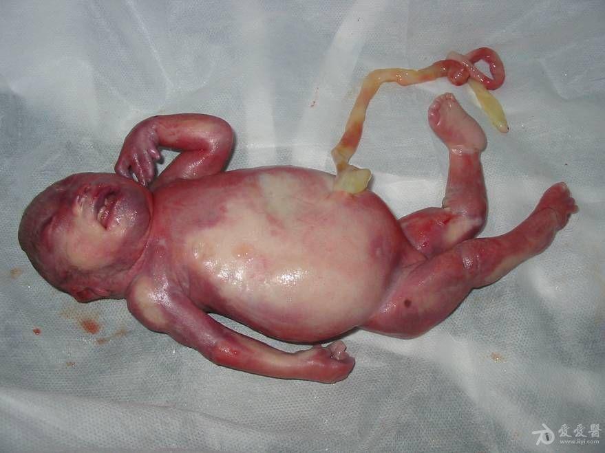 一组婴儿型多囊肾图像加引产后图片