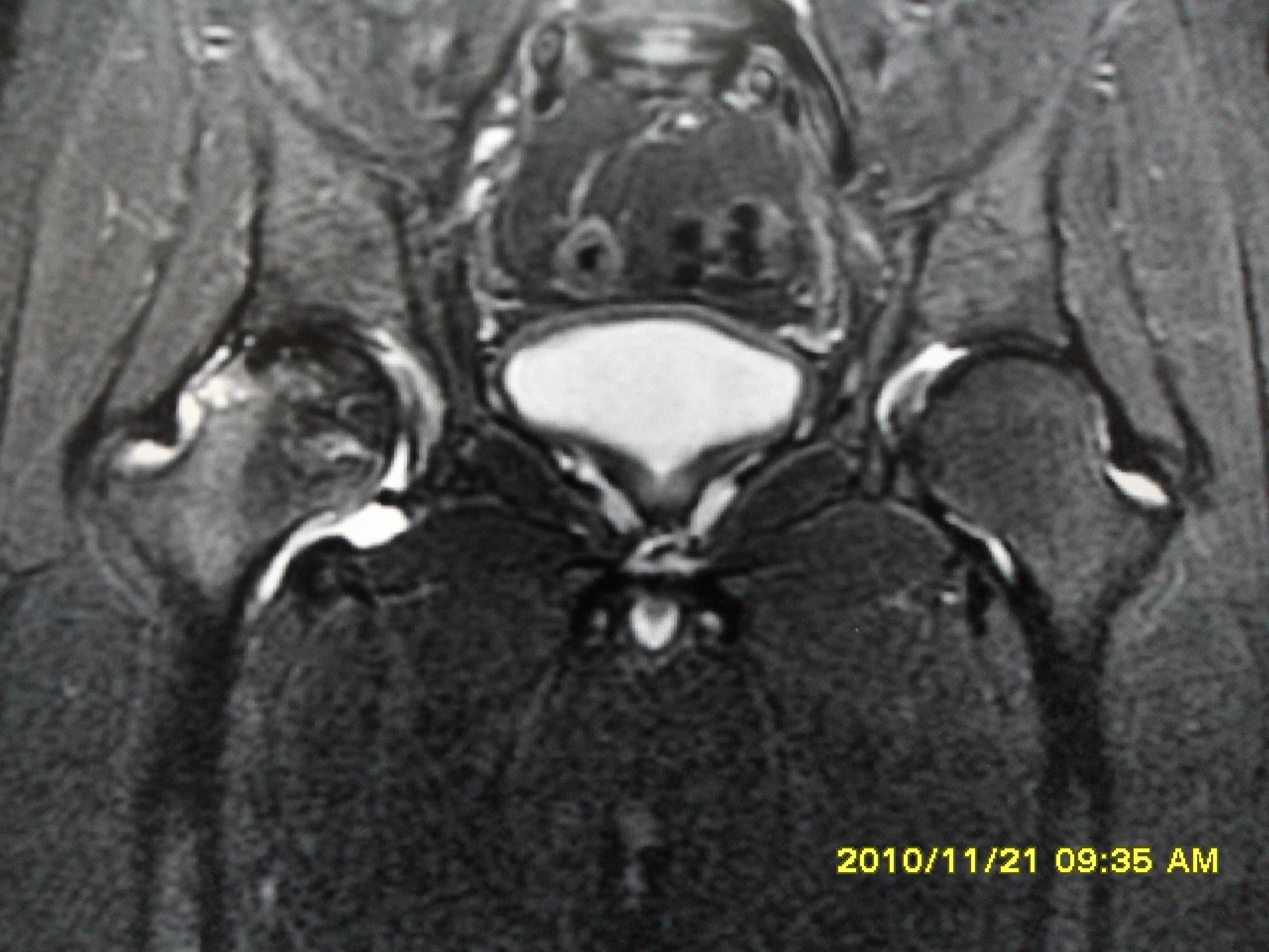 股骨头坏死MRI图片