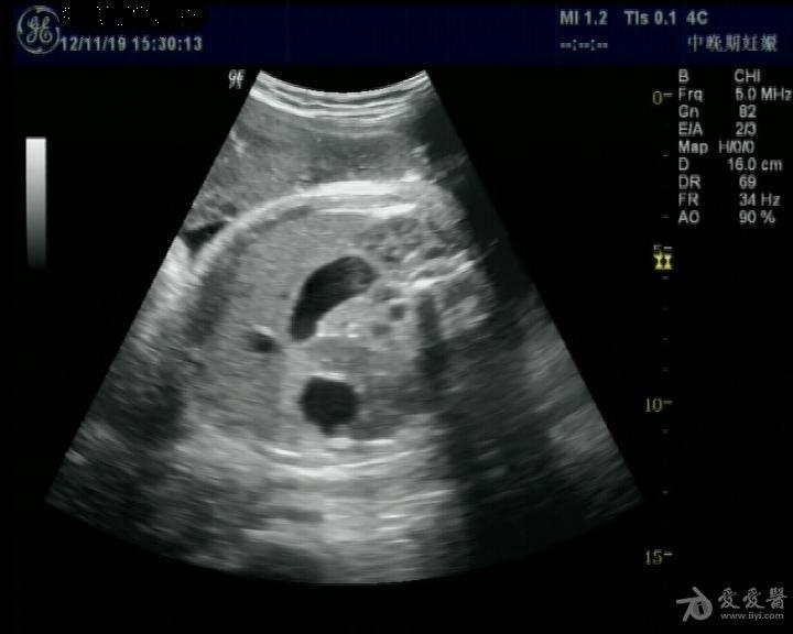 胎儿腹部双泡征