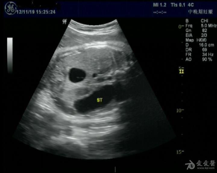 胎儿双叶征超声图片图片