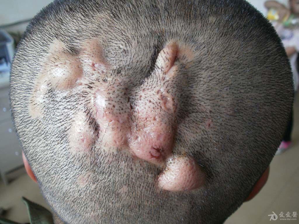 病例分享头部脓肿性穿掘性毛囊炎大家是如何治疗的